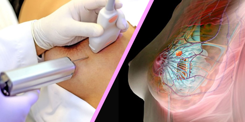 Que se puede detectar en una biopsia Que se puede detectar en una biopsia